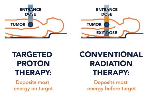 Proton therapy deposits most of its energy on the tumour; regular radiation keeps going past it